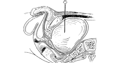 Пункция мочевого пузыря