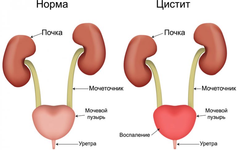 Что делать при цистите девушке дома