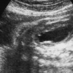 Гидронефроз почек у плода при беременности: причины, чем это опасно, лечение
