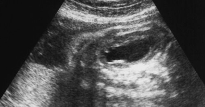 Гидронефроз почек у плода при беременности