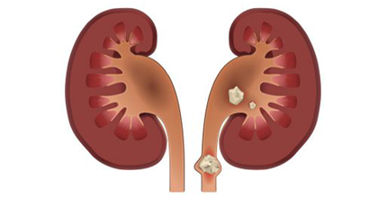 Кальцинаты в почках