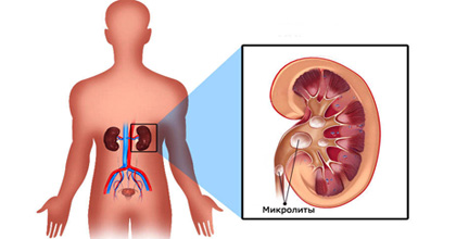 Микролиты в почках