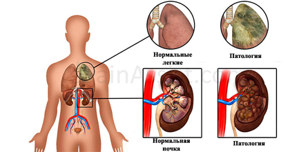 Синдром Гудпасчера