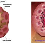 Пиелонефрит и гломерулонефрит: сравнение и чем они отличаются