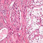 Почечно-клеточный рак почки: причины, прогноз и лечение