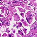 Светлоклеточный рак почки: симптомы, лечение и прогноз