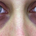 Могут ли почки быть причиной синяков под глазами?