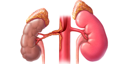 Стеноз почечной артерии
