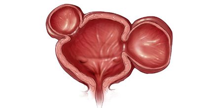 Дивертикула мочевого пузыря