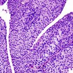 Переходноклеточный рак мочевого пузыря: что это, прогноз и лечение